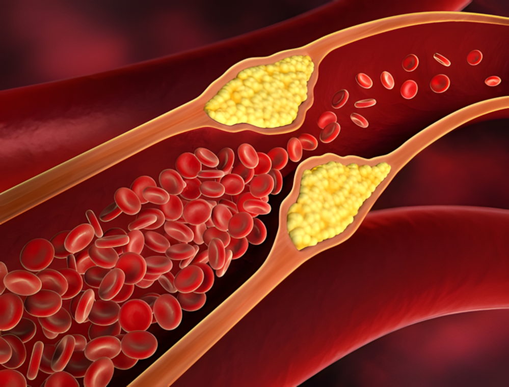 Cholesterin senken auf natürliche Weise: Geht das?