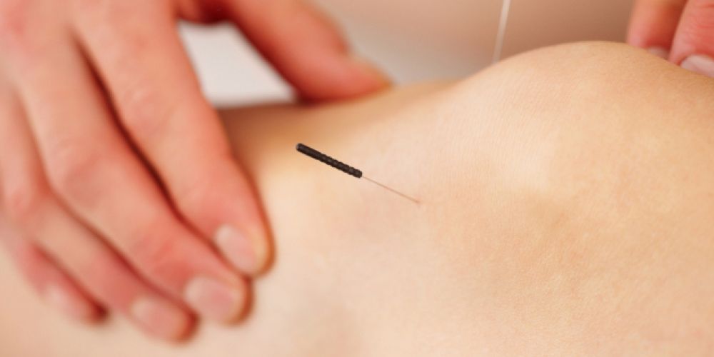 Schmerzbehandlung durch Akupunktur