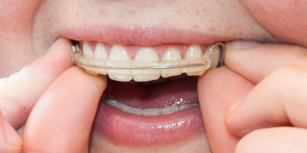 Zahnspangen für Kinder