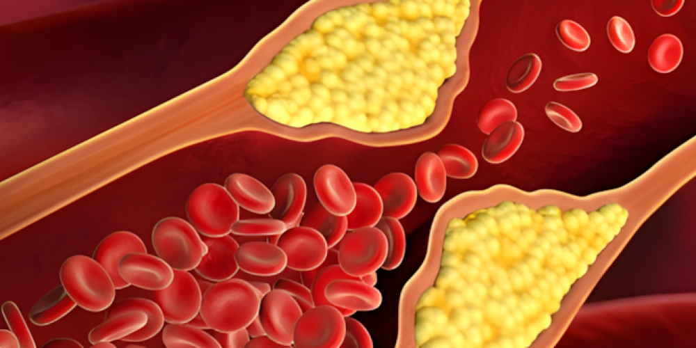 Cholesterin senken auf natürliche Weise: Geht das?