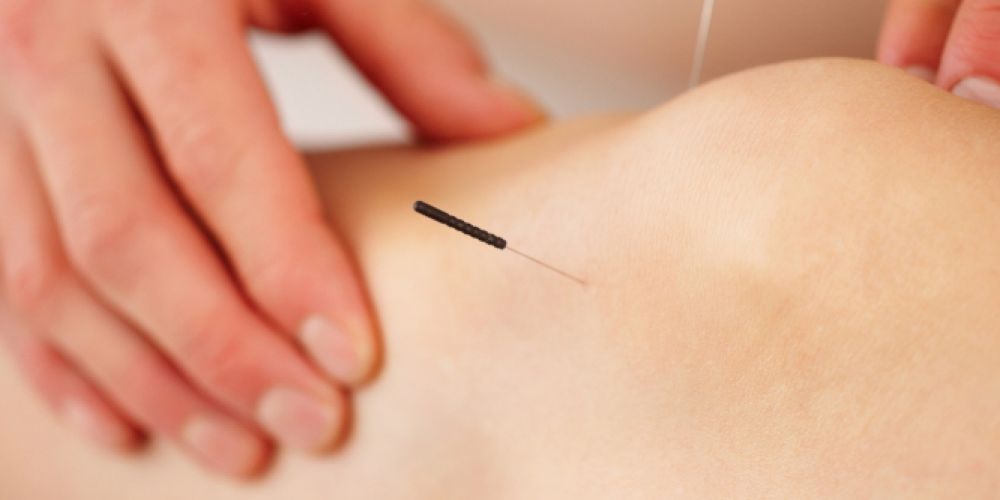 Schmerzbehandlung durch Akupunktur