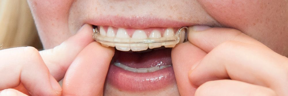 Zahnspangen für Kinder