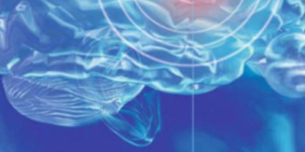 Wie ein niedriger Cholesterinspiegel Schlaganfällen vorbeugen kann